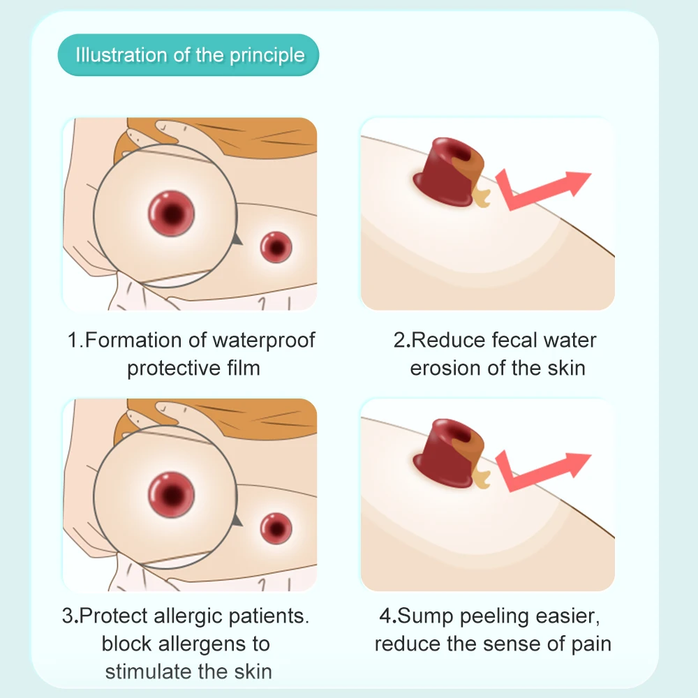 Рисунок 3 - защита кожи от стомы без спирта