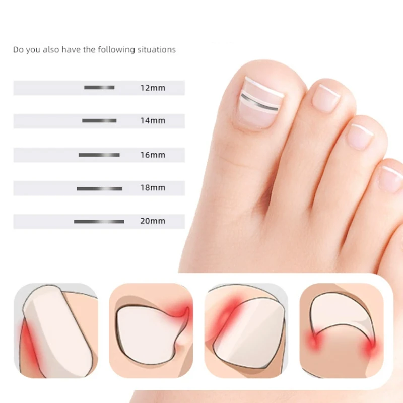 Strumento per la protezione delle dita dei piedi per la correzione dell'unghia del piede incarnita Adesivo per il trattamento delle unghie Strumento per pedicure della paronichia
