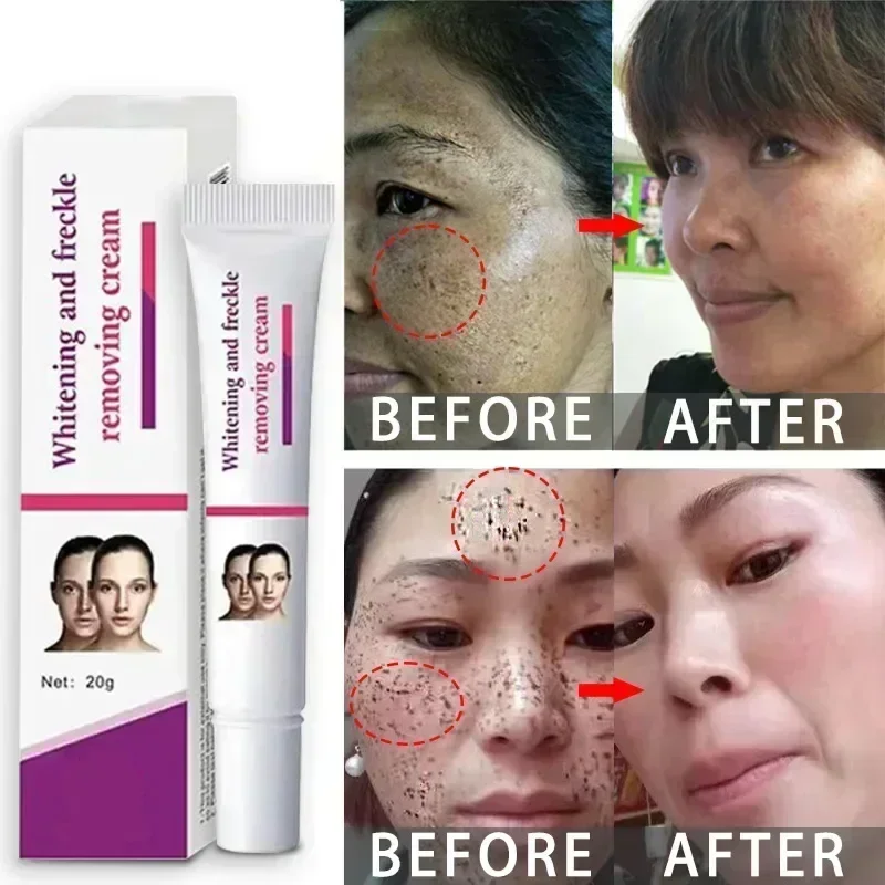 

Facial Spots Cream Freckles Removal Skin Dark Spot Remove Melasma Age Spots Sunspots Whitening And Freckle Removing Cream