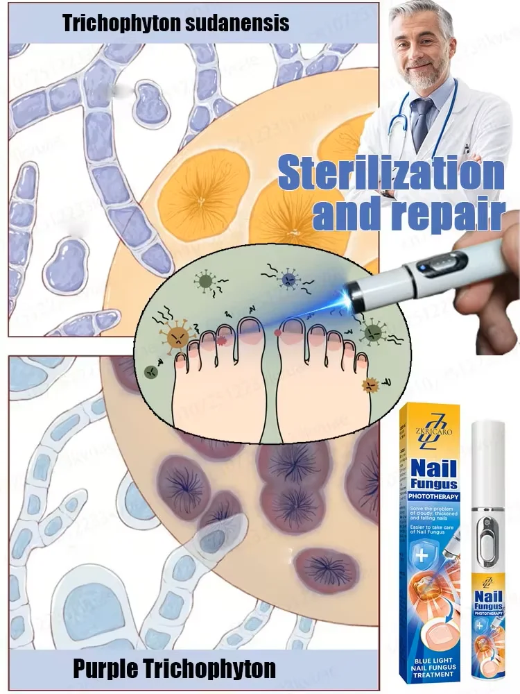 Laserowy aparat do leczenia grzybicy paznokci, bezbolesna i skuteczna alternatywa do leczenia grzybicy paznokci u stóp, domowe leczenie i regeneracja zdrowia paznokci u stóp.