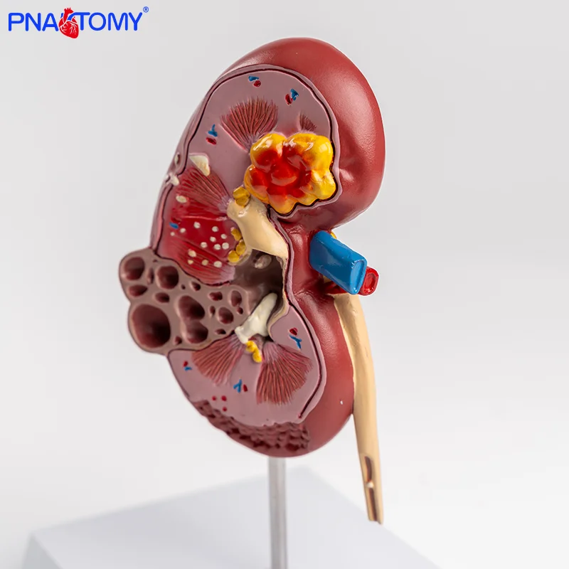 

Анатомическая модель почки человека, медицинский обучающий инструмент для патологической структуры, демонстрация мочевой системы, висцеральный орган