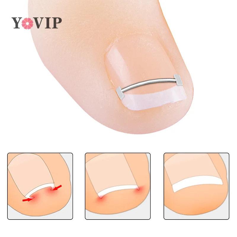 10 Stuks Ingegroeide Teennagel Corrector Tools Pedicure Herstellen Insluiting Teen Nagel Behandeling Professionele Teennagel Correctie Voetverzorging Tool