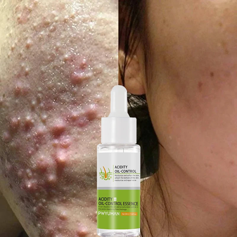 

Acne Treatment Facial Serum Scar Pimples Marks Remover Products Oil Control Moisturizing Shrink Pores Brighten Smooth Skin Care