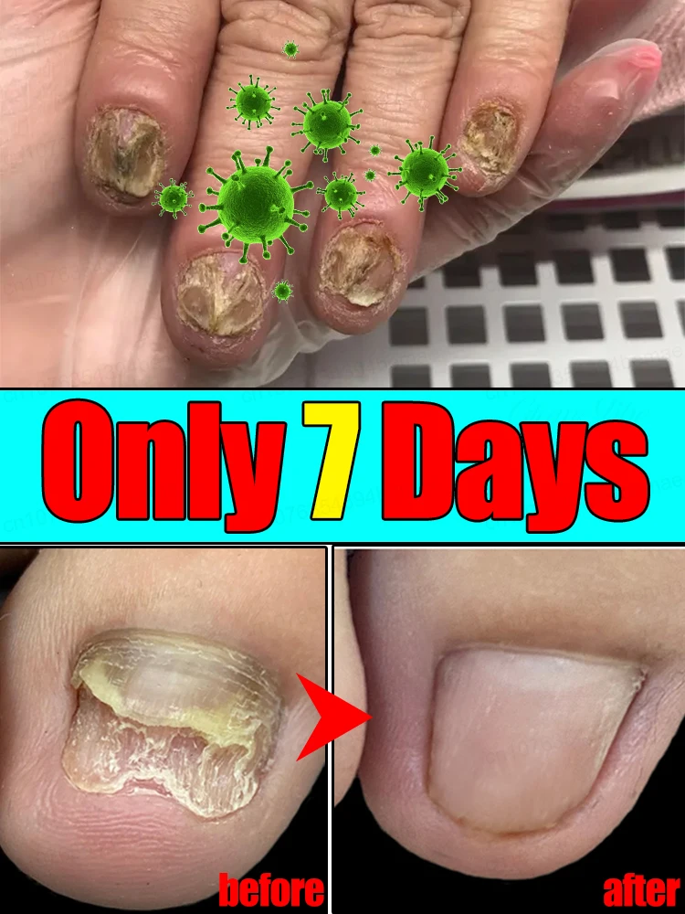 

Eʟɪᴍɪɴᴀᴛᴇ ʙᴀᴄᴛᴇʀɪᴀ ᴀɴᴅ ᴍᴀᴋᴇ ɴᴀɪʟs ɢʀᴀᴅᴜᴀʟʟʏ sᴍᴏᴏᴛʜ ᴀɴᴅ ғʟᴀᴛ uuuuuuu