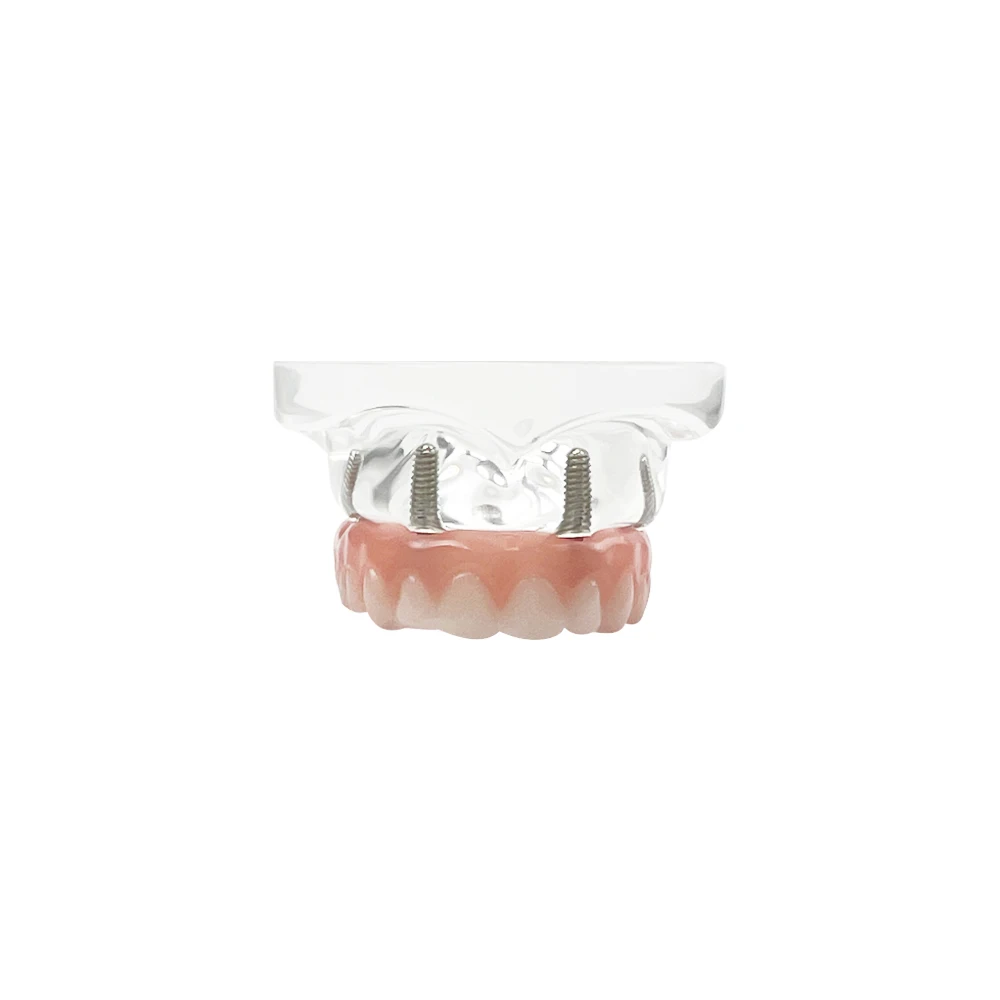 Dental Overdenture Teeth Model With Removable Recondition Implants Upper/Lower Jaw All On 4 Implant Model For Education Teaching