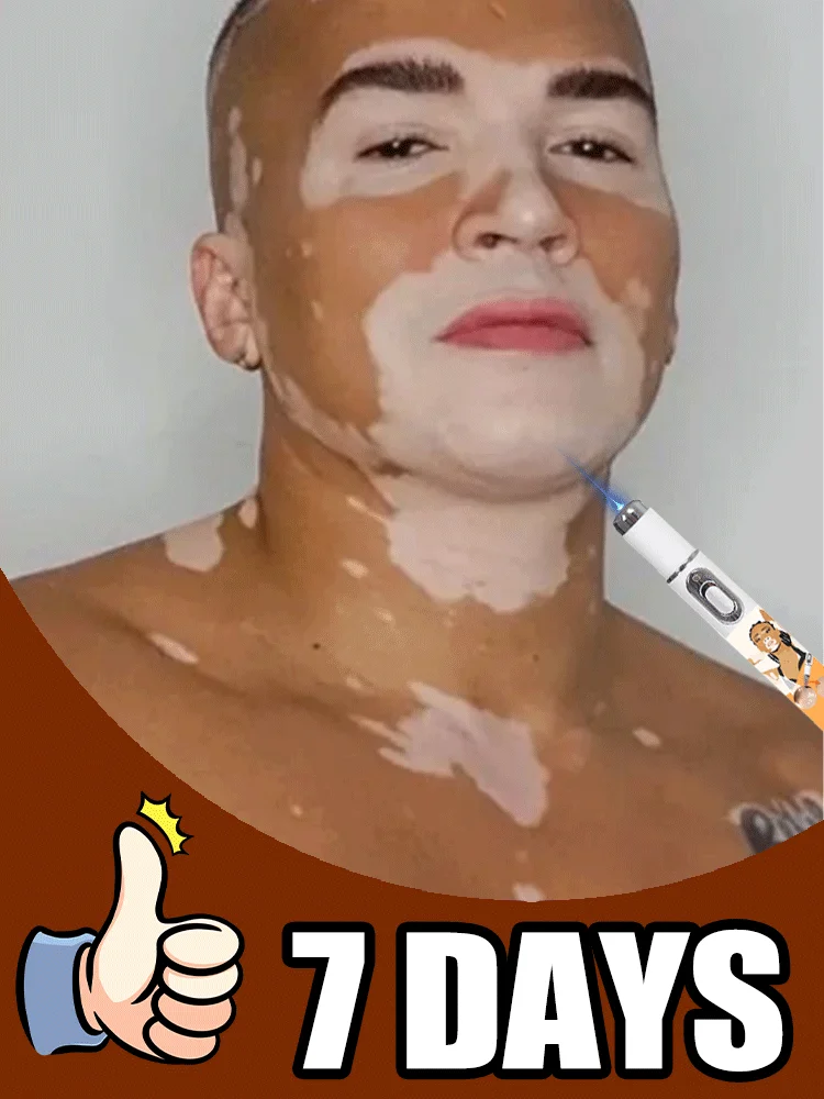 

Generation-1 Laser Says Goodbye To Vitiligo In 7 Days