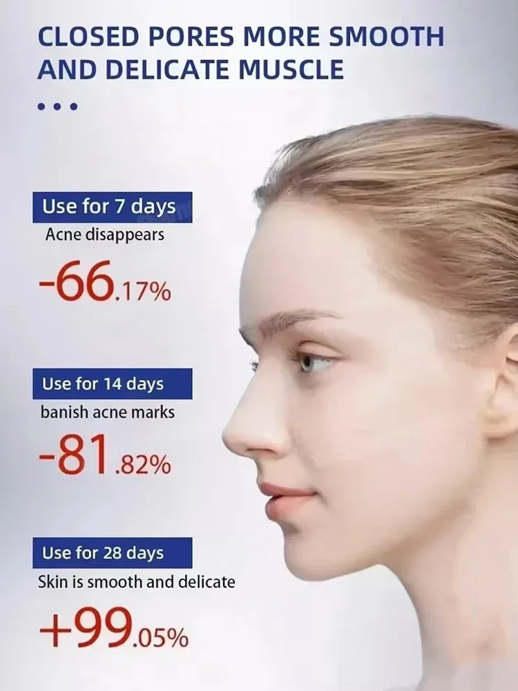 3RD محلول حمض الساليسيليك جوهر حب الشباب إزالة بقعة تقليص المسام السيطرة على النفط سطع المصل ، تقليل حب الشباب ، ترطيب ، تهدئة