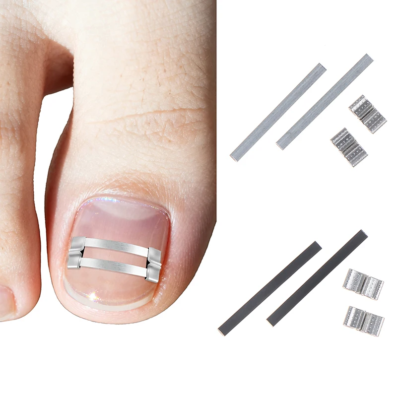 Ingrown Toenail Straightening Brace Tools Professional Ingrown Toenail Correcto…