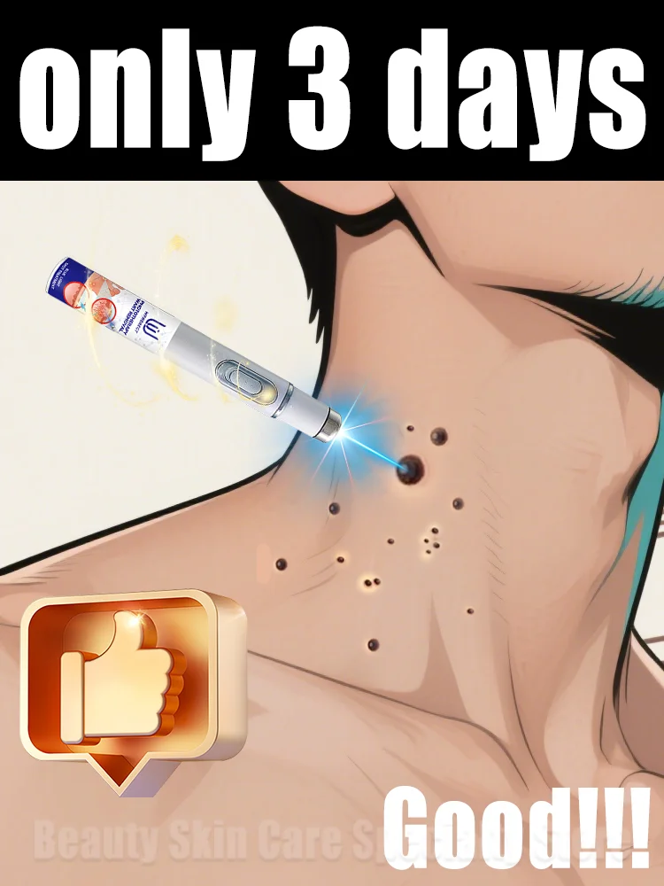 

Generation-2 laser says goodbye to all warts in 7 days