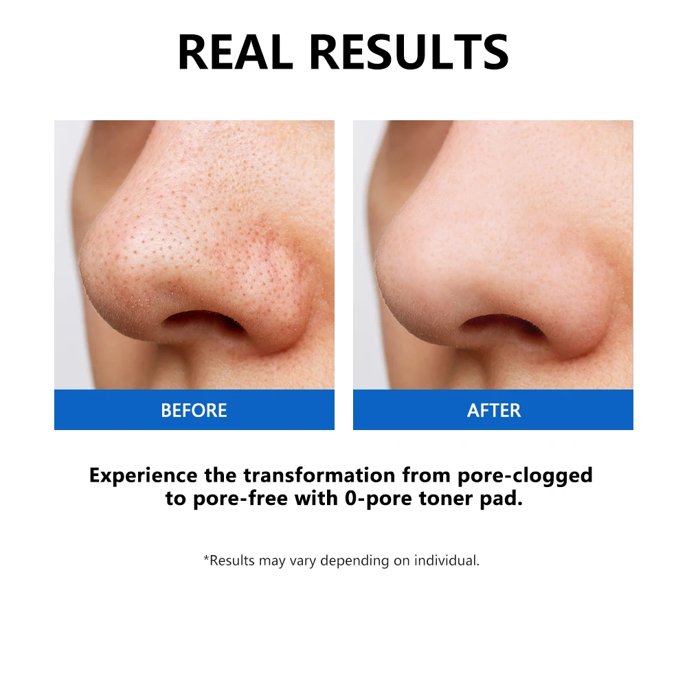 منصات الحبر صفر المسام التحكم النفط تقليل الزهم تقشير تنظيف عميق ينقي المسام المضادات للأكسدة العناية بالبشرة العناية بالبشرة الكورية