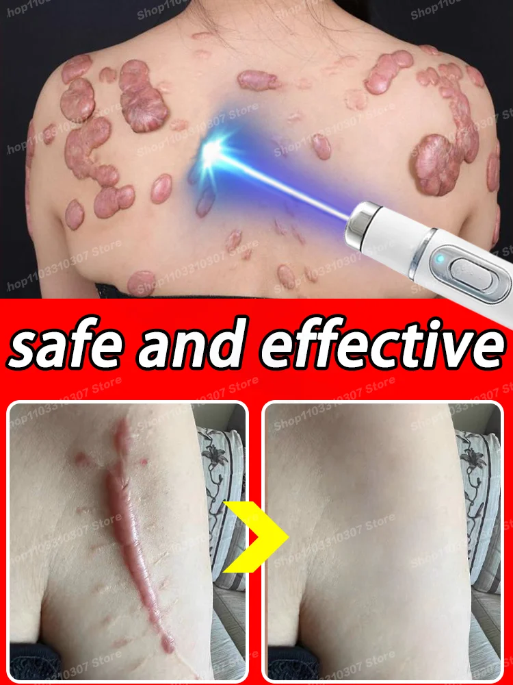 Scars  Fast Repair Removing  Keloid