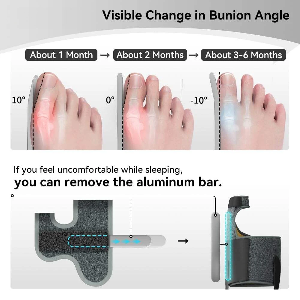 SplendocBig Parker Straightener Spacer, Bunion Ration Tors, Hallux Valgus oto, Instituts Protection, Non-ald, 1 paire