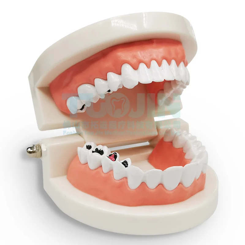 Dental child tooth decay model, kindergarten brushing teaching nursing model, oral teaching dental pathology model
