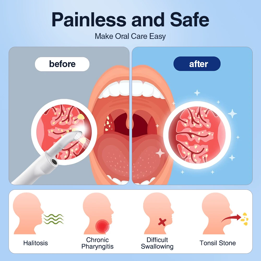 طقم إزالة حجر اللوزات الكهربائية المرئية مع 3 أوضاع شفط أداة العناية بالفم لإزالة أحجار اللوزيل والعناية بالفم الطازجة #5
