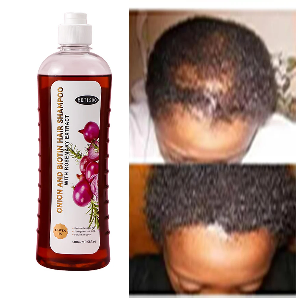 

Hair Shampoo For Fast Hair Growth Rosemary Onion Hair Regrowth Shampoo Anti Hair Loss Effective Within 7 Day Hair Growth Product