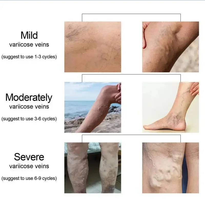 Alivio efectivo de las venas varicosas. Vasculitis, flebitis, araña calmante para piernas