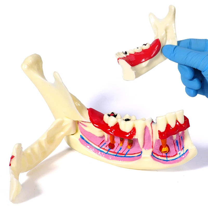 Lower Gingival Side Mandibular Decomposing Model Anatomical Teaching Demonstration Can Open Surgical Tool for Dental Education