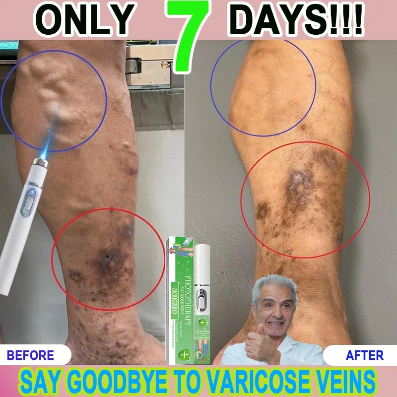 Say goodbye to varicose veins