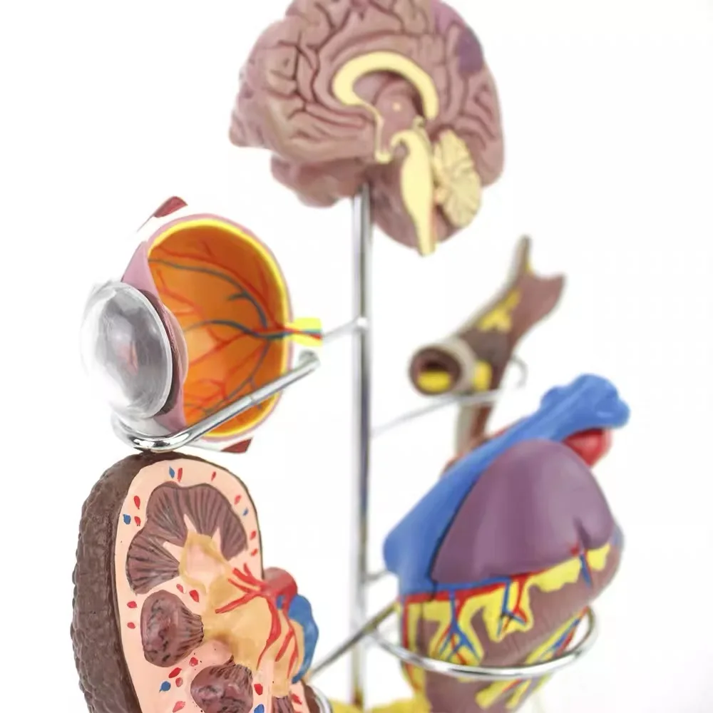 Modelo de órgano humano para la Diabetes, modelo anatómico desmontable, suministros de anatomía médica, herramienta educativa de enseñanza