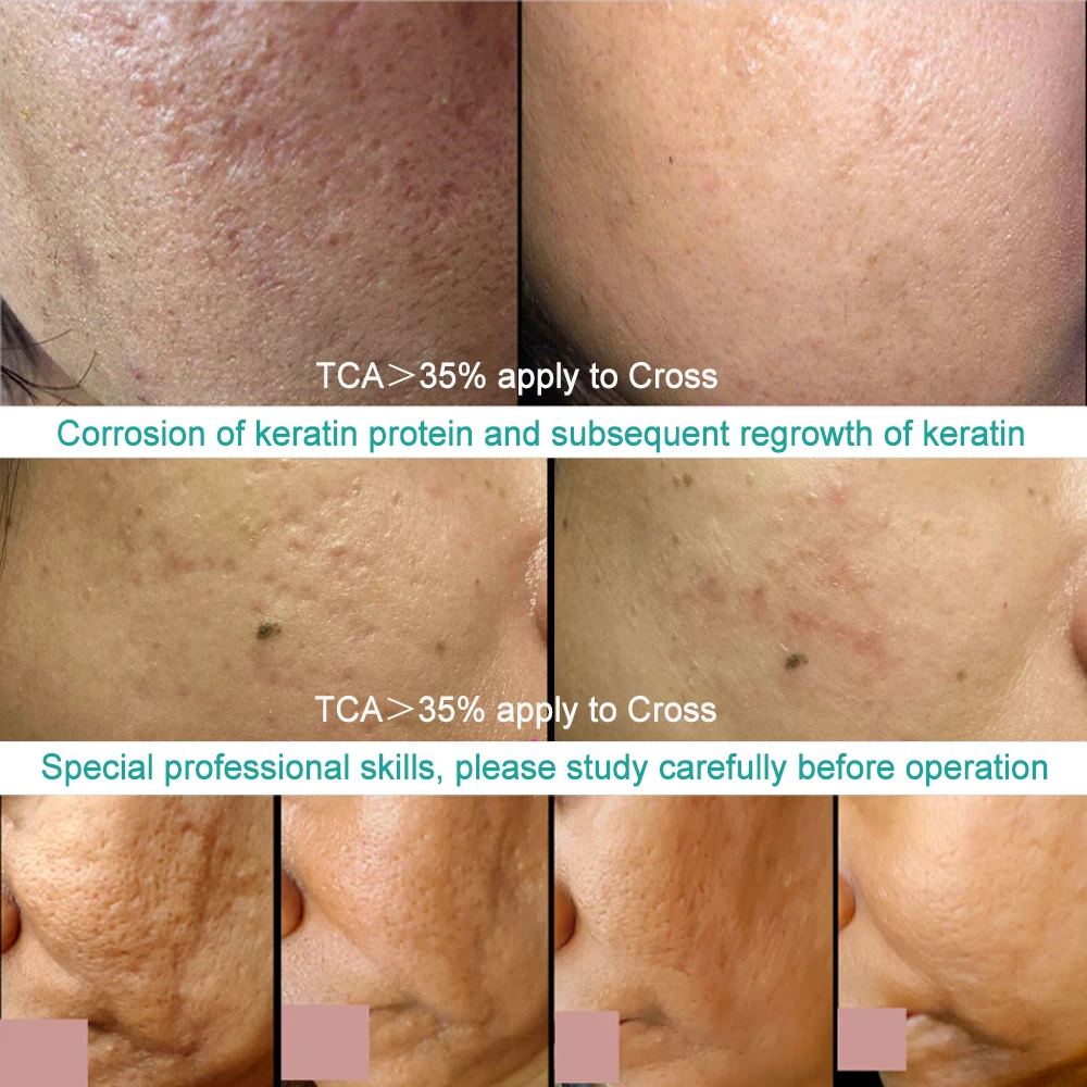 Skin Rejuvenation TCA 20 35 50 70 Peel for Sun Damage Fine Lines Wrinkles Dull Skin Uneven Skin Tone Enlarged Pores Melasma