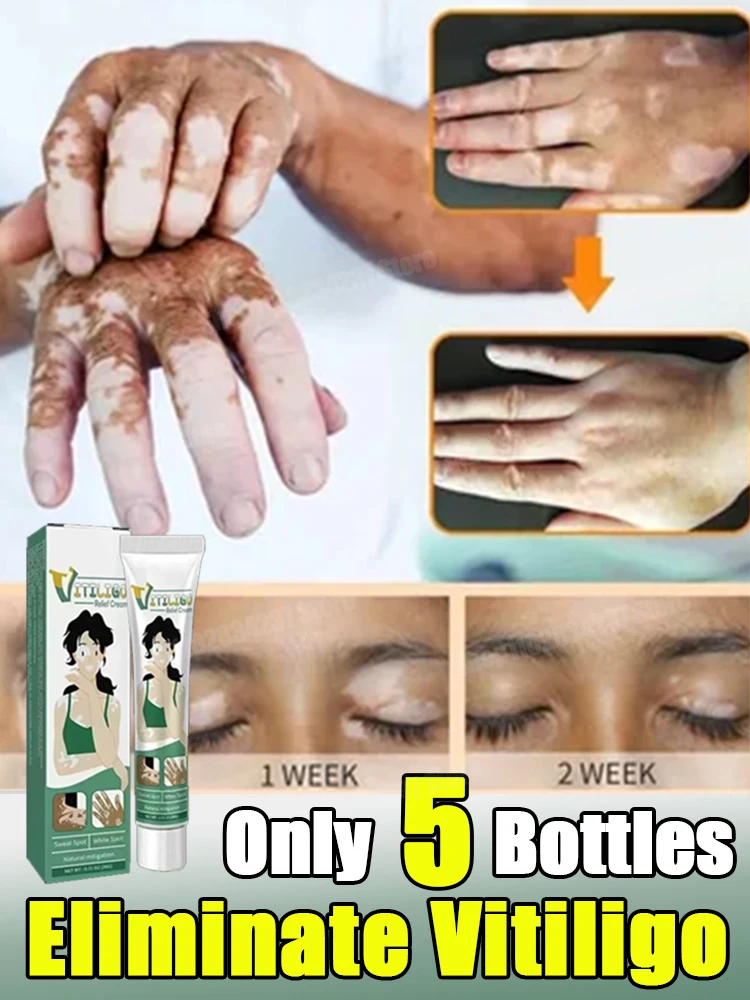 

Vitiligo Cream Remove Ringworm White Spot Removal Skin Vitiligo Eliminate Vitiligo Cream Body Skin Care