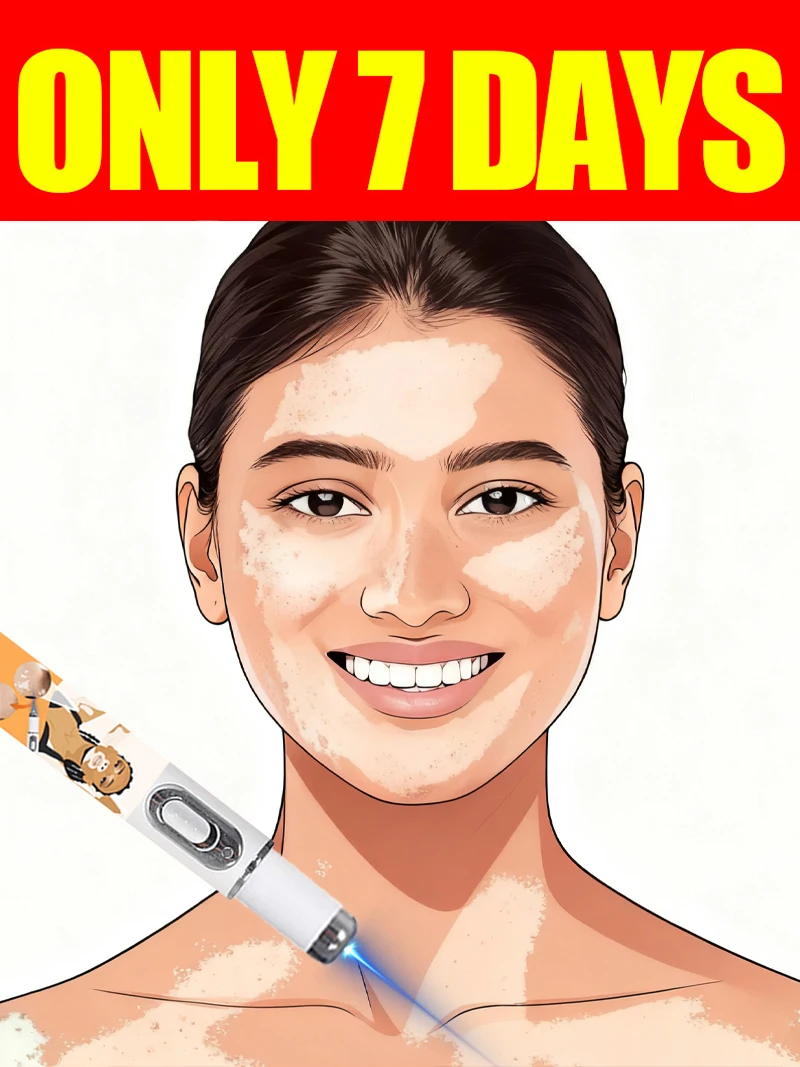 Generation-2 Laser Says Goodbye To Vitiligo In 7 Days