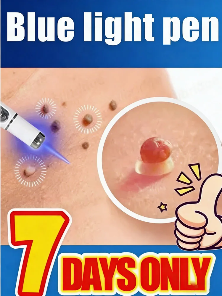 

2026 upgraded versionBlue light pen solve all warts, wart laser tools