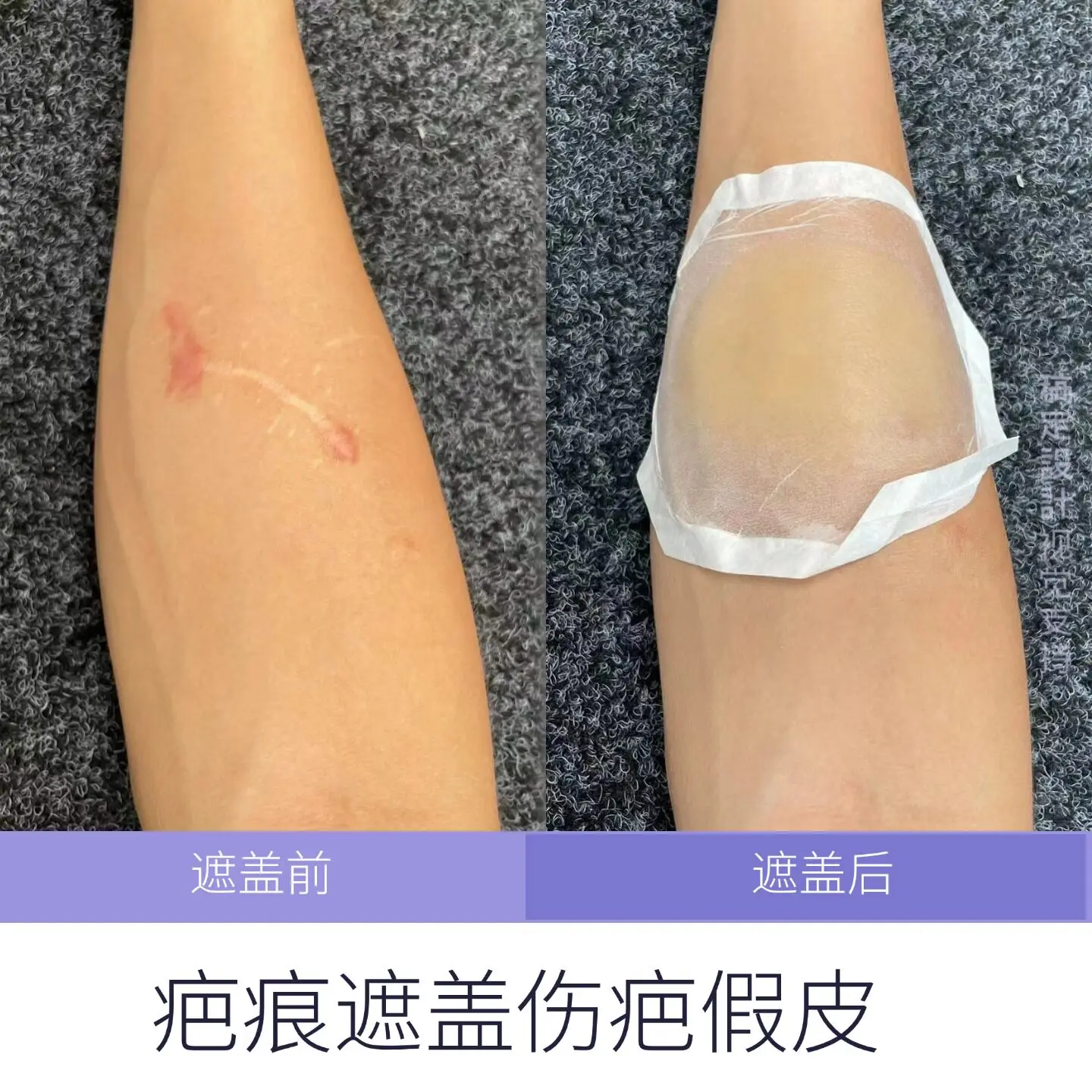 Customizable Convex Scar Cover Fake Leather Silicone Ultra-thin Fit No Mark Cover Fake Leather