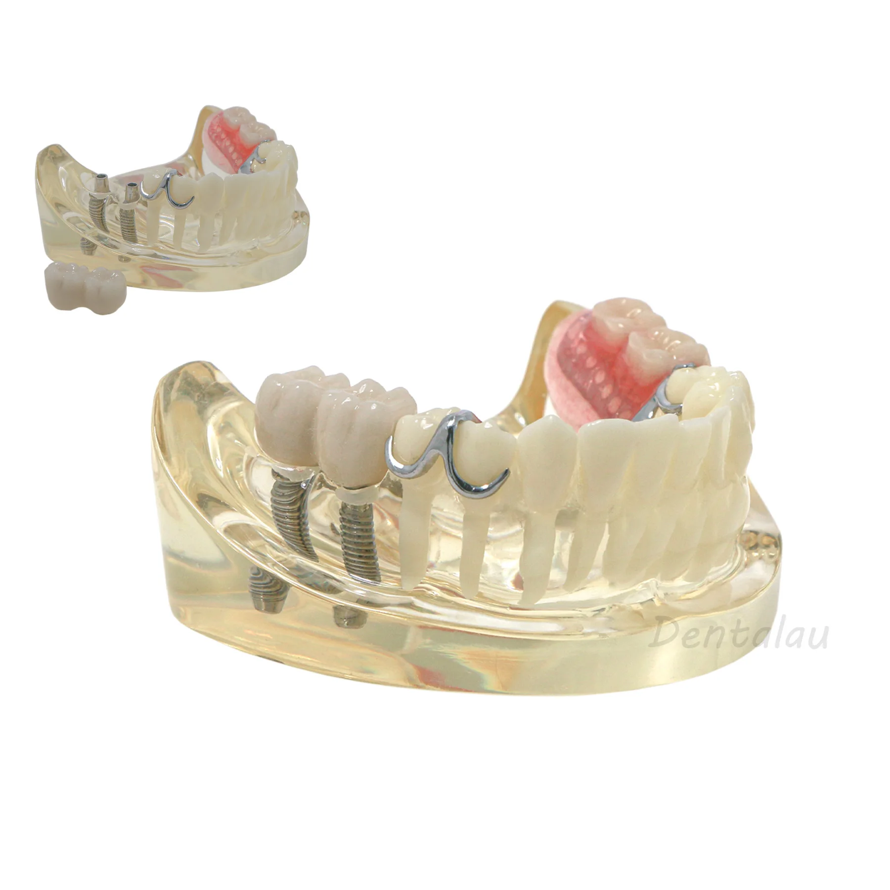 Dental Implant and Restpration Typodont Teeth Model with Partial Denture M6022