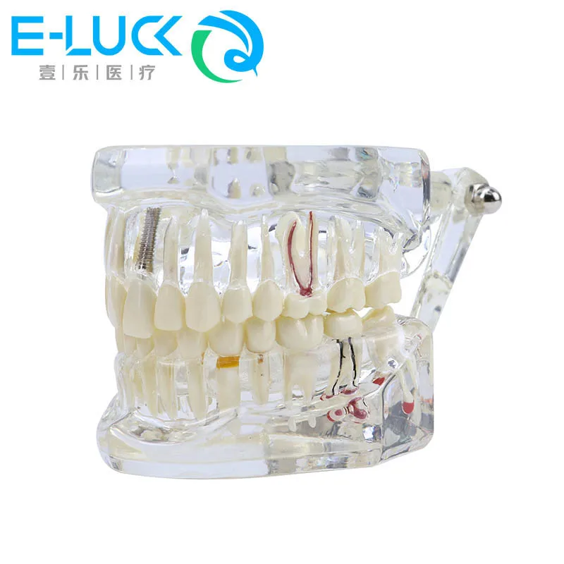 

Dental Teaching Teeth Model Teeth Pathological Implant with Nerve Transparent Pathology Preventive Model