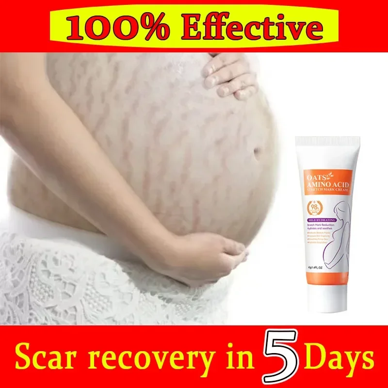 

Stretch Marks Permanent Removal Cream Eliminate Body Belly Stretch Marks Swelling Marks Remove Skin Cracks Repair Firming Care