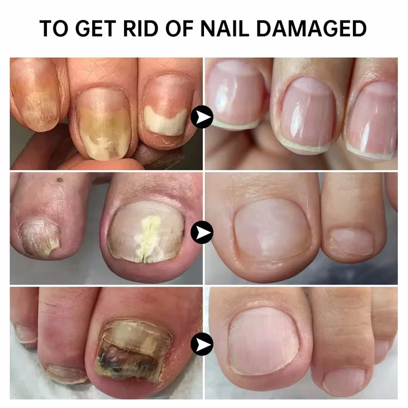 Nail Fungus Care Solution Anti-Infection Onychomycosis Repair Damaged Cracked Hand Foot Nail Manicureed Health Care Essence