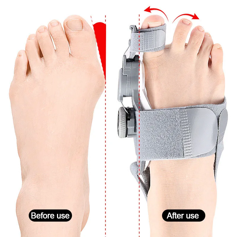 

Kids Bunion Corrector Foot Hallux Valgus Braces Rotatable Toe Separator Straightener Adjustable Pedicure Finger Toe Corrector