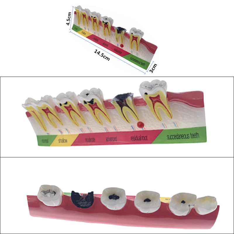 Dental Caries Classify Tooth Model of Pathological Process Around Teeth Caries Evolution Decayed Model Dentist Lab Tool