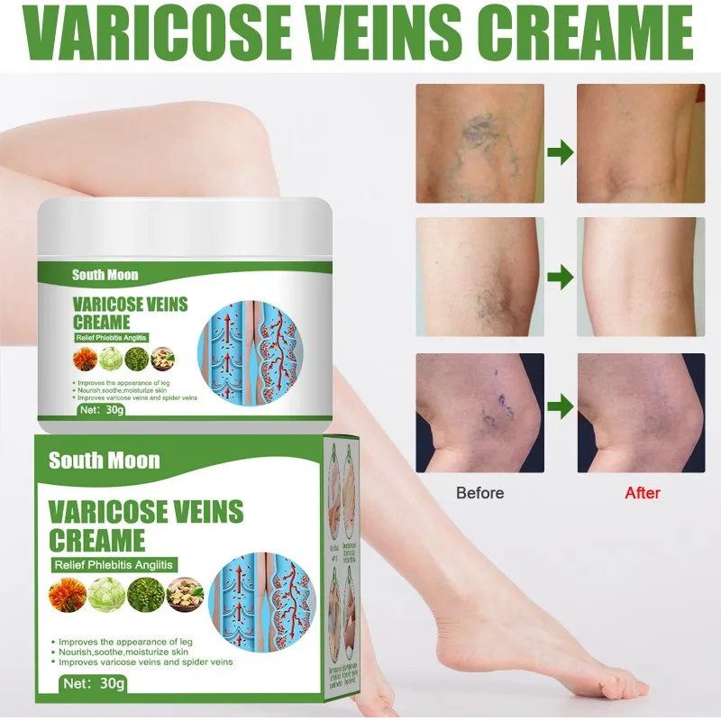 Crema per la rimozione delle vene Varicose efficace allevia il rigonfiamento delle gambe riparazione del trattamento del dolore elimina la vasculite flebite cura del corpo naturale