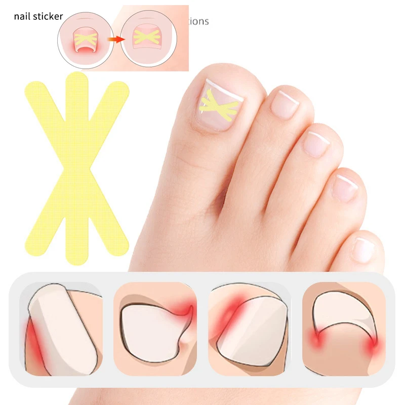 10 pçs nova forma clipe de correção de unha encravada pedicure ferramentas do dedo do pé tratamento de unhas elástico alisamento clipe cinta