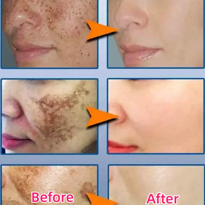 Effictive Dark Spot Remover Cream for Face Removing Freckle Melasma Chloasma Senile Plaques Sunburn Cyasma Chorioplaque Freckle