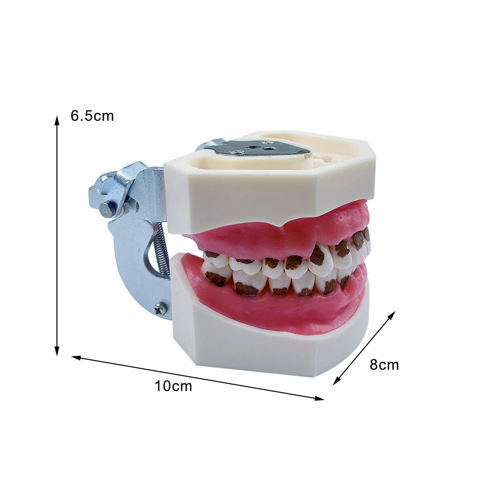 Dental Periodontal Disease Model 28 Teeth Periodontitis Study Model with Calculus Detachable Teeth for Dental Teaching Practice