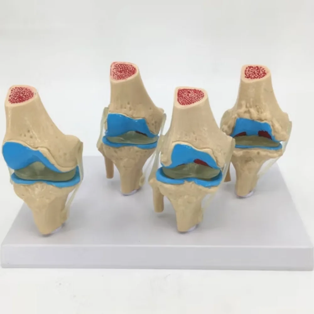 Pathological knee model Four-stage pathological knee model