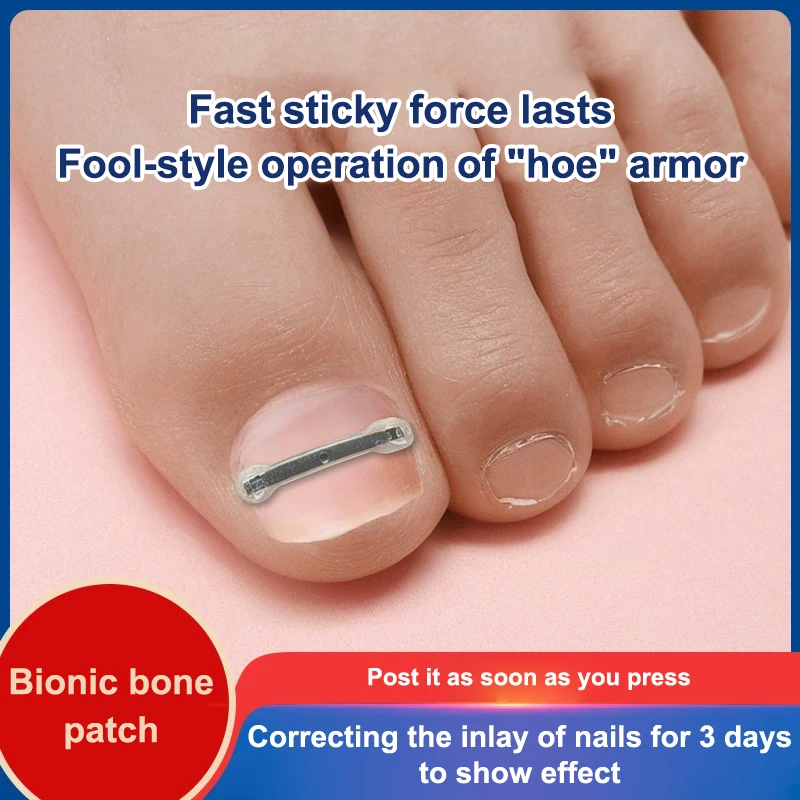 12Pcs Ingrown Toenail Treatment Kit With 4 Multi-Sizes,Titanium Alloy Ingrown Nail Corrector Tools For Curved Toenail Corrector