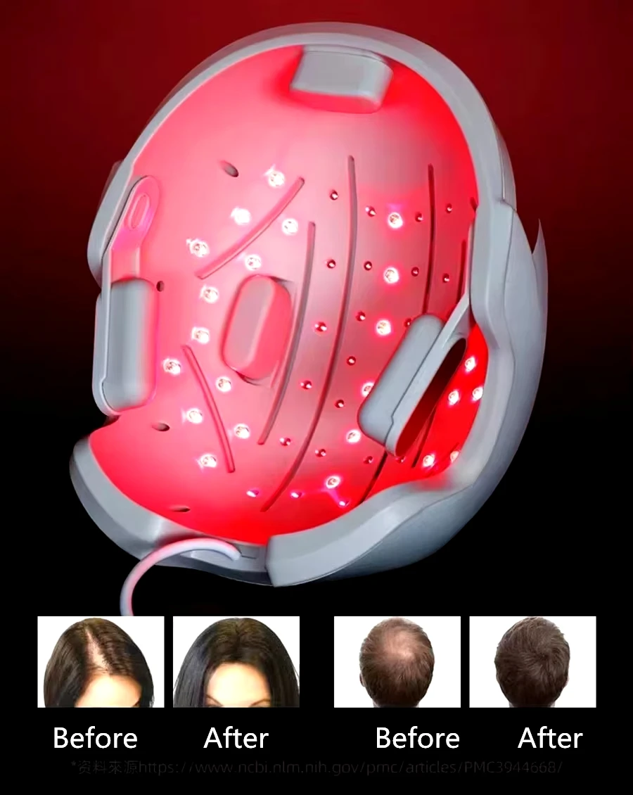 Men Hair Growth Cap LLLT Helmet Laser Hair Regrowth Hair Loss Laser Treatment Hair Fast Growth Anti Hair Loss Device