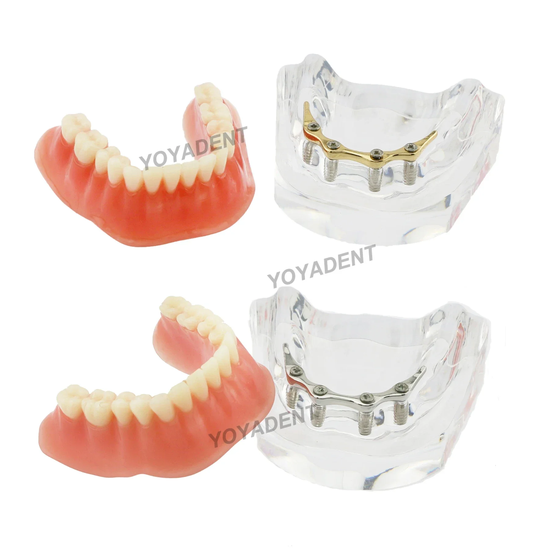 

Dental Implant Teeth Model Removable Overdenture 4 Implants Inferior For Dentist Patient Communication Treatment Study Demo