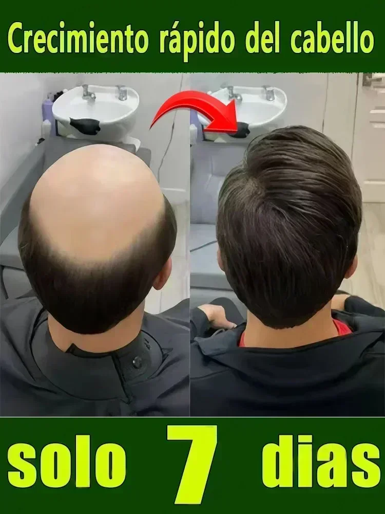 Hot selling product, 99% of buyers buy again, have more and more hair, say goodbye to baldness, thick hair