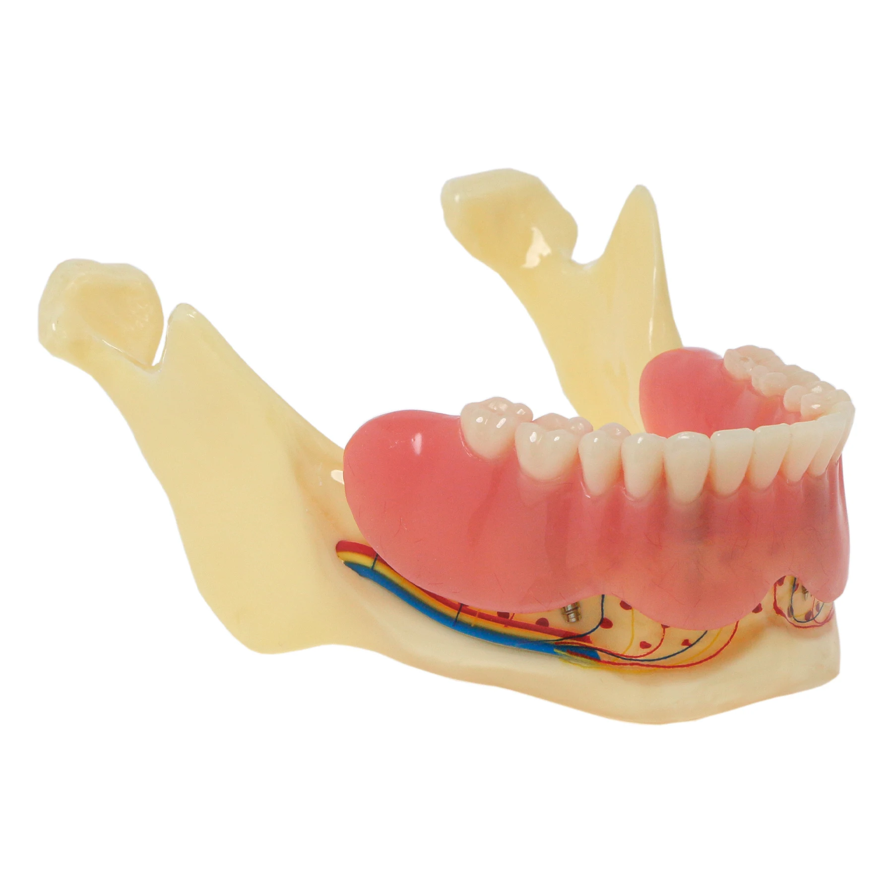 Dental Typodont  Implant  Demo Practice Model With Removable Overdenture Teeth  M6005