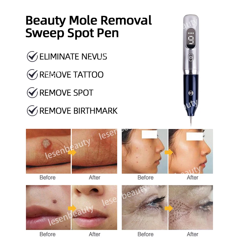 Laserverwijdering Van Verructe Naevus Skin Tag Sproeten Zwarte Stippen Papilloma Verrucous Naevus Acne Tattoo Laser Pen Led Display Less