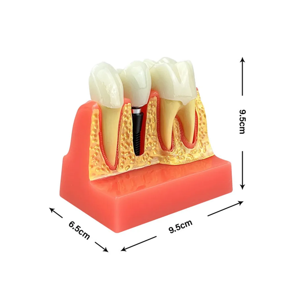 Diş Implant modeli 4 kez Implant analizi taç köprüsü çıkarılabilir Model diş hekimliği gösteri diş çalışması Model beyin