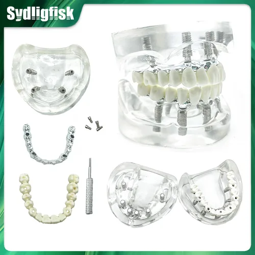 Imagen 1 del producto Modelo Dental, modelo de restauración de implantes, modelo de sobredentadura removible maxilar con 4 implantes, modelo educativo para estudiantes de dentista