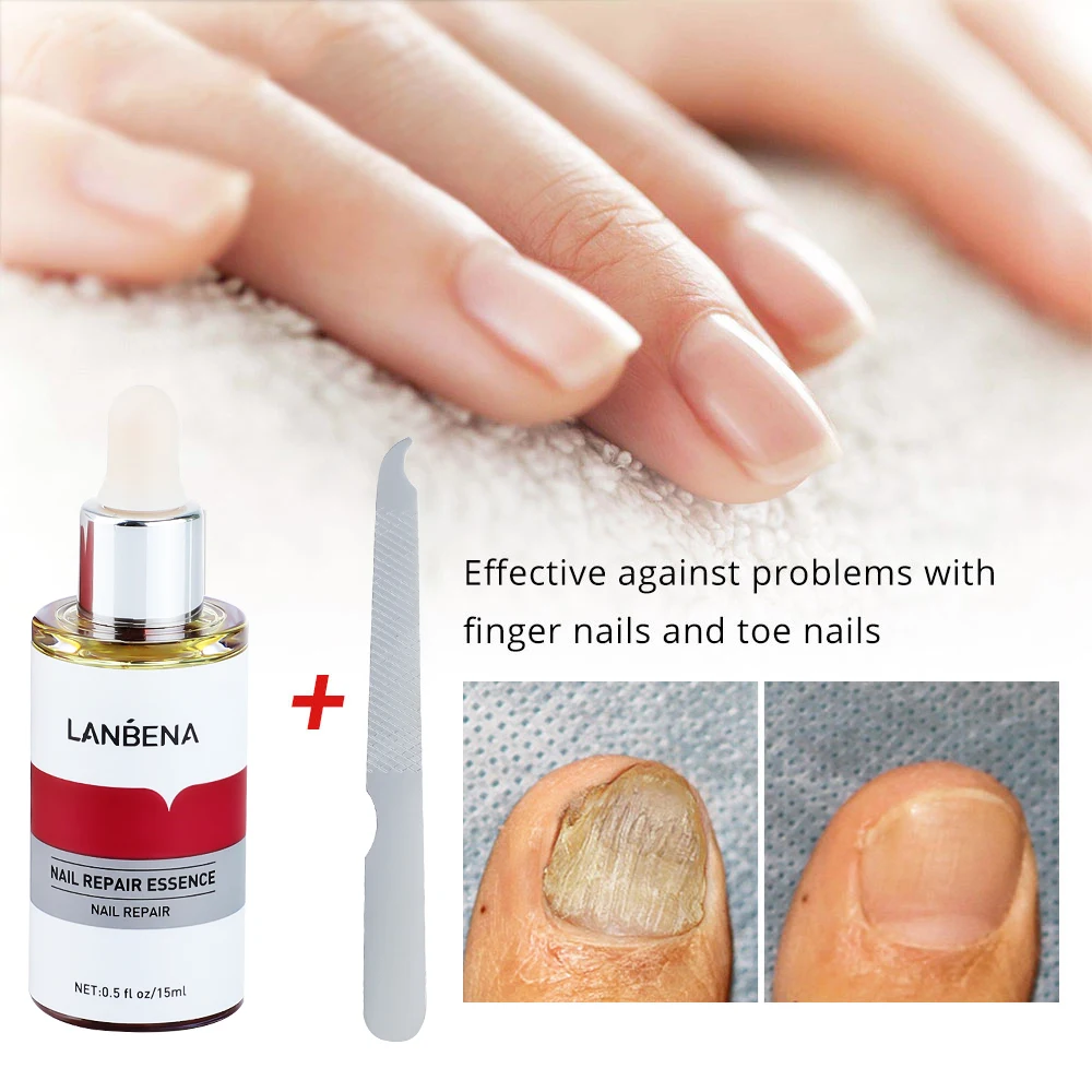 LANBENA 15ml Nail Repair Essence Serum Anti Infection Paronychia Onychomycosis Treatment Foot Care Nail Fungus Removal Gel