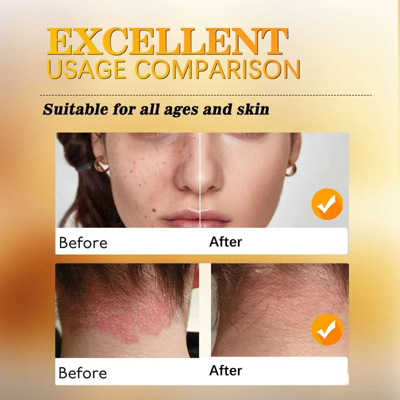 

Bee venom skin care cream cleanses and removes moles, leaving the skin smooth, moisturizes, and lightens. Soothing care cream