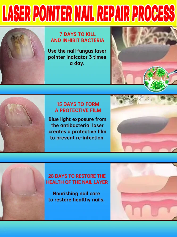 Las uñas pasan de estar opacas a transparentes. El spray para hongos en las uñas es testigo del milagro.